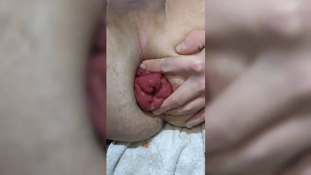 Pumping anal prolapse